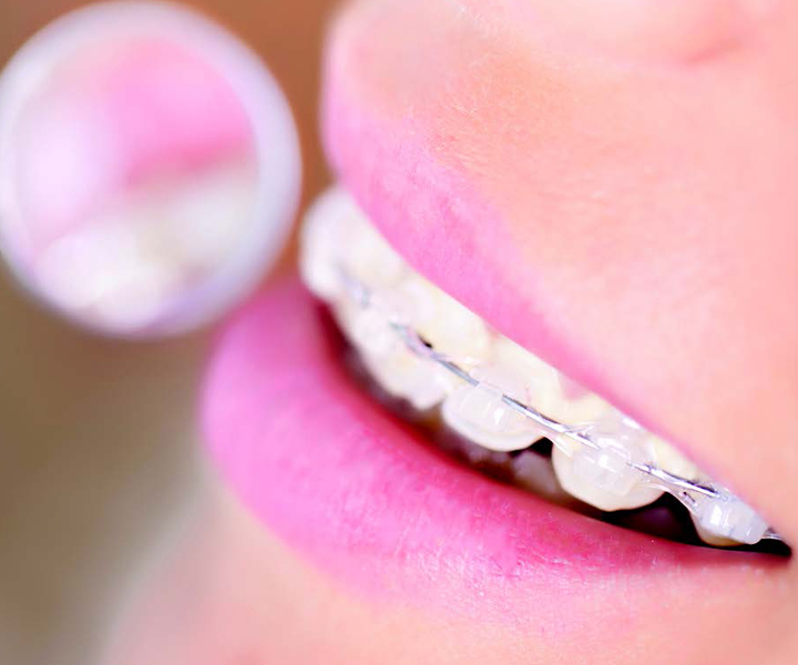 Benefits of Damon Braces