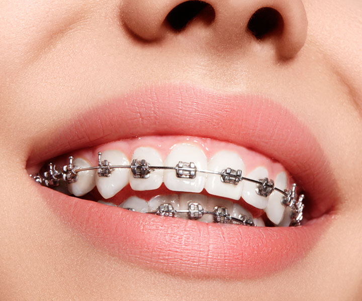 Our Other Service Metallic Braces